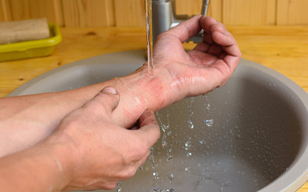 Hot Tips to Avoid Sick Burns