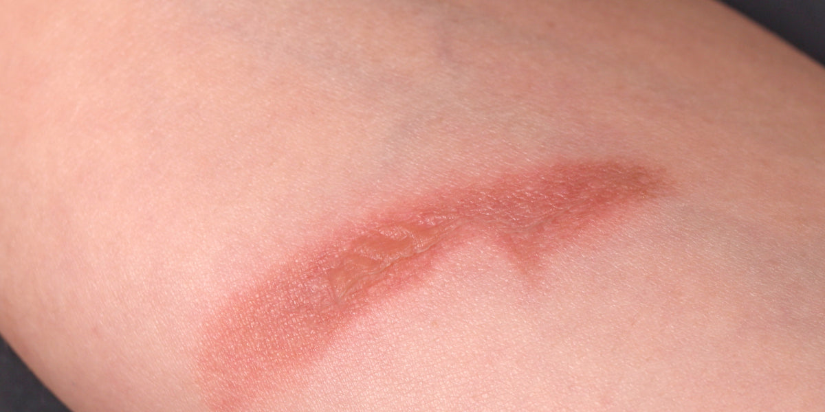 Forearm with burn.