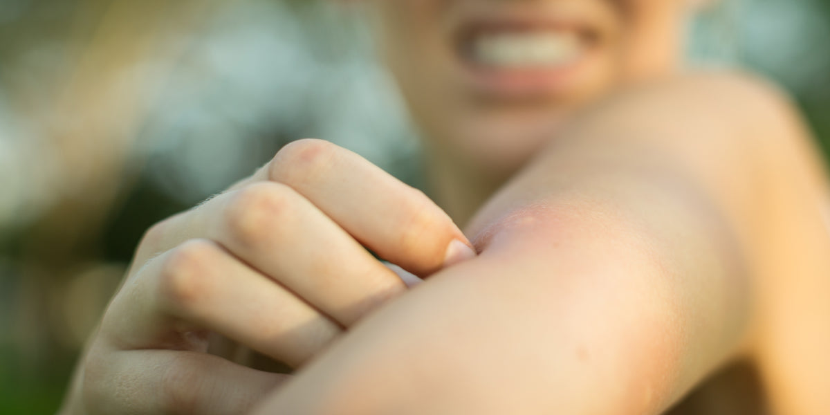 Woman itching upper arm mosquito bites.