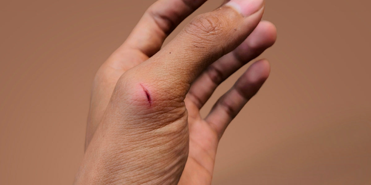 Small Sharp Cut How to Treat Minor Cuts, Help Them Heal with First Aid Spray | Dermoplast®